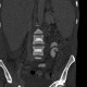 Unknown pathology of spine: CT - Computed tomography